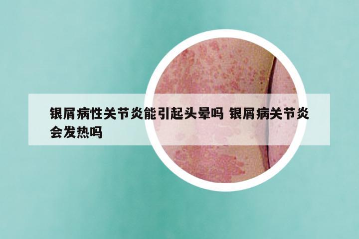 银屑病性关节炎能引起头晕吗 银屑病关节炎会发热吗