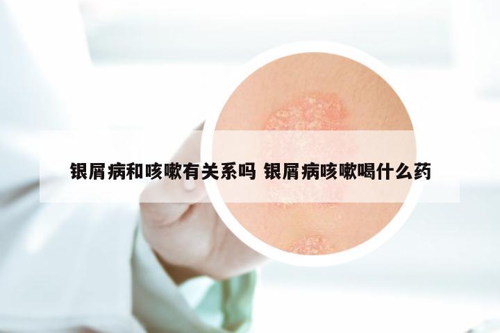 银屑病和咳嗽有关系吗 银屑病咳嗽喝什么药