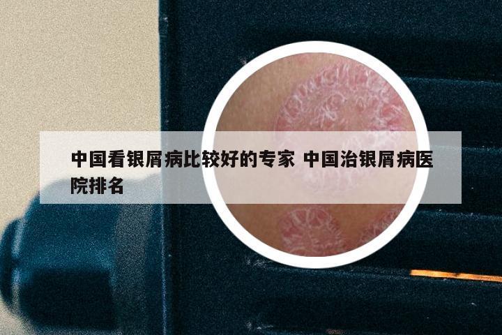 中国看银屑病比较好的专家 中国治银屑病医院排名