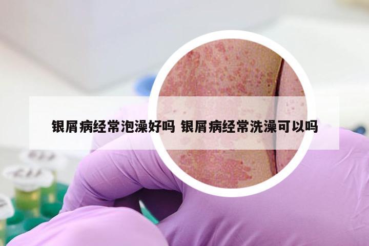 银屑病经常泡澡好吗 银屑病经常洗澡可以吗