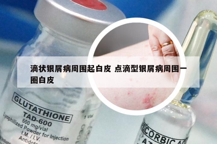 滴状银屑病周围起白皮 点滴型银屑病周围一圈白皮