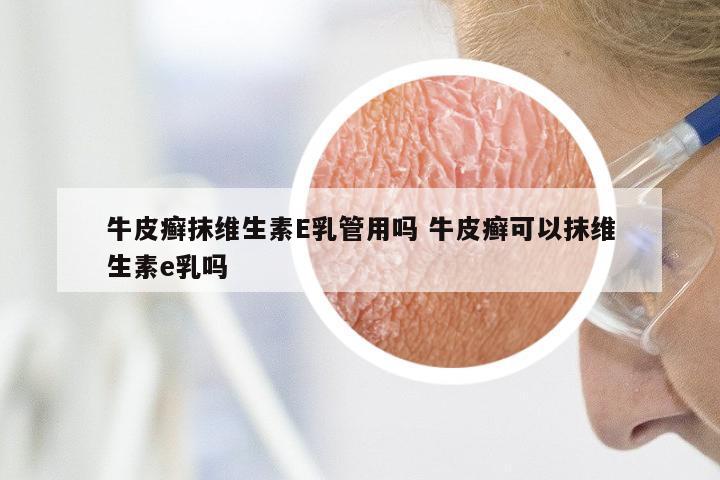 牛皮癣抹维生素E乳管用吗 牛皮癣可以抹维生素e乳吗