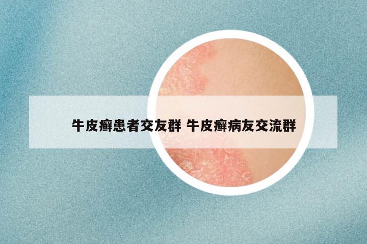 牛皮癣患者交友群 牛皮癣病友交流群