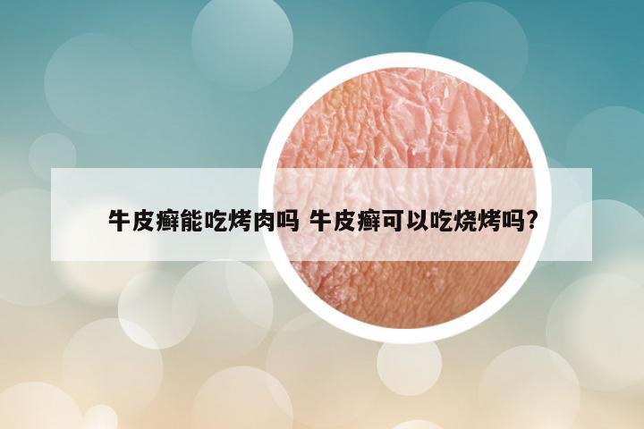 牛皮癣能吃烤肉吗 牛皮癣可以吃烧烤吗?