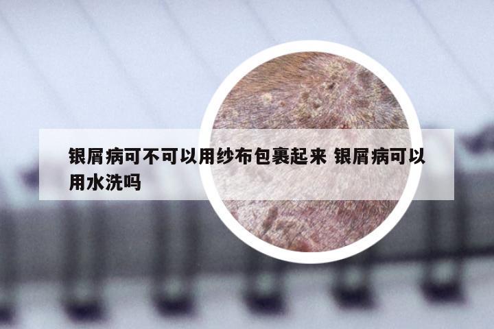 银屑病可不可以用纱布包裹起来 银屑病可以用水洗吗