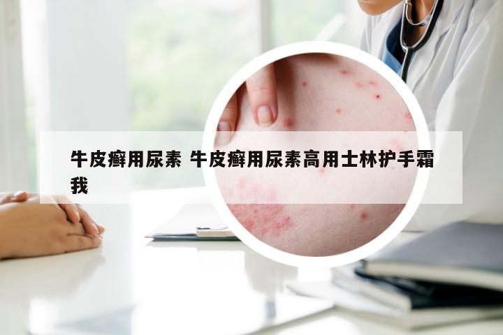 牛皮癣用尿素 牛皮癣用尿素高用士林护手霜我