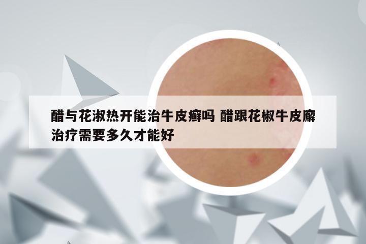醋与花淑热开能治牛皮癣吗 醋跟花椒牛皮廨治疗需要多久才能好