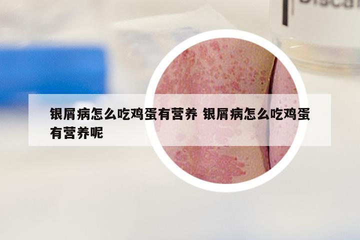 银屑病怎么吃鸡蛋有营养 银屑病怎么吃鸡蛋有营养呢