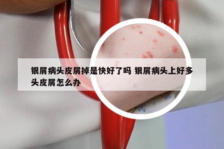 银屑病头皮屑掉是快好了吗 银屑病头上好多头皮屑怎么办