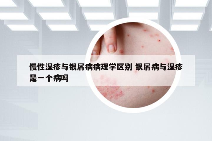 慢性湿疹与银屑病病理学区别 银屑病与湿疹是一个病吗