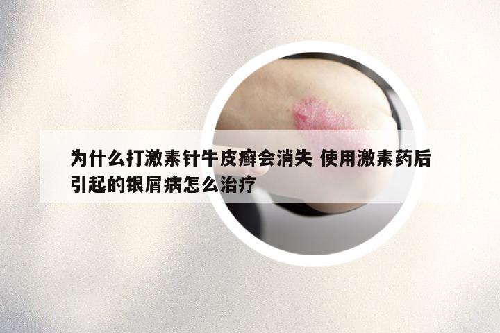 为什么打激素针牛皮癣会消失 使用激素药后引起的银屑病怎么治疗