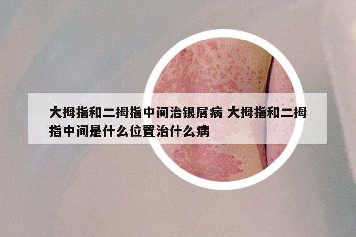 大拇指和二拇指中间治银屑病 大拇指和二拇指中间是什么位置治什么病