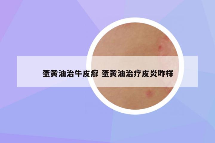 蛋黄油治牛皮癣 蛋黄油治疗皮炎咋样