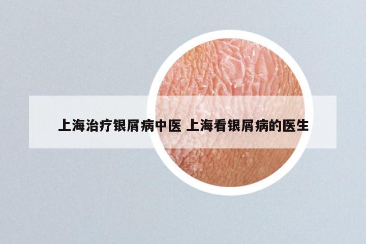 上海治疗银屑病中医 上海看银屑病的医生
