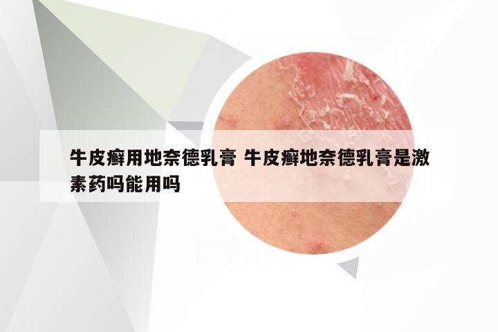 牛皮癣用地奈德乳膏 牛皮癣地奈德乳膏是激素药吗能用吗