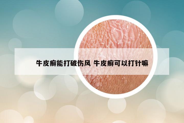 牛皮癣能打破伤风 牛皮癣可以打针嘛