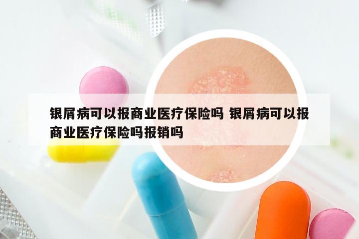 银屑病可以报商业医疗保险吗 银屑病可以报商业医疗保险吗报销吗