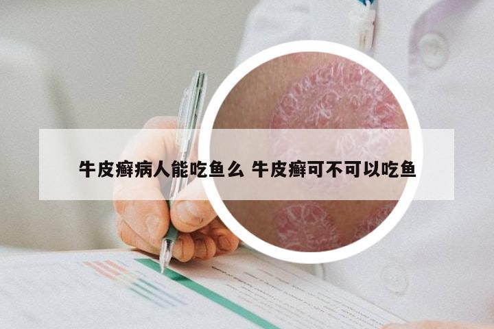 牛皮癣病人能吃鱼么 牛皮癣可不可以吃鱼