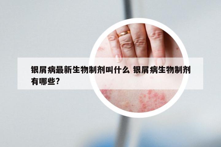 银屑病最新生物制剂叫什么 银屑病生物制剂有哪些?