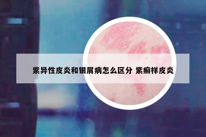 紫异性皮炎和银屑病怎么区分 紫癣样皮炎