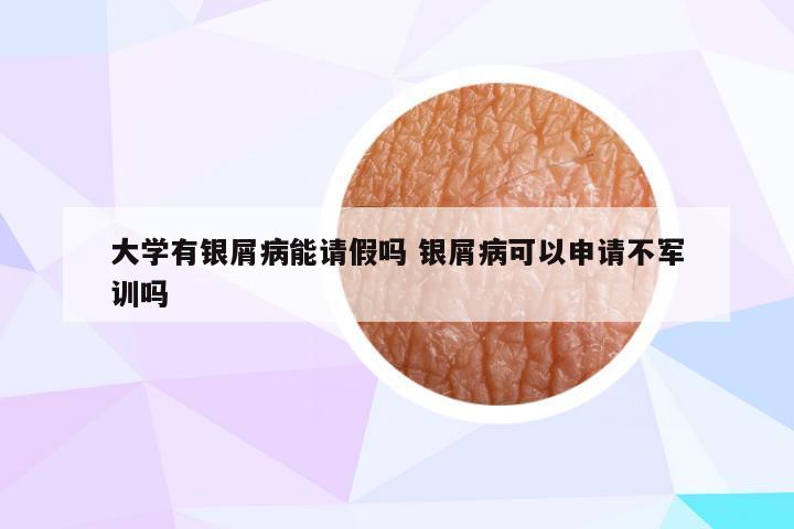 大学有银屑病能请假吗 银屑病可以申请不军训吗