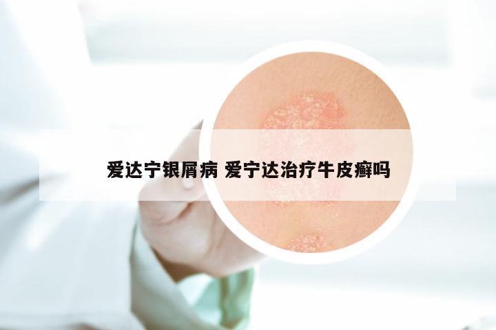爱达宁银屑病 爱宁达治疗牛皮癣吗