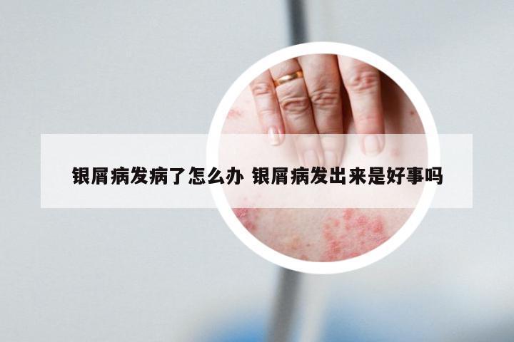 银屑病发病了怎么办 银屑病发出来是好事吗