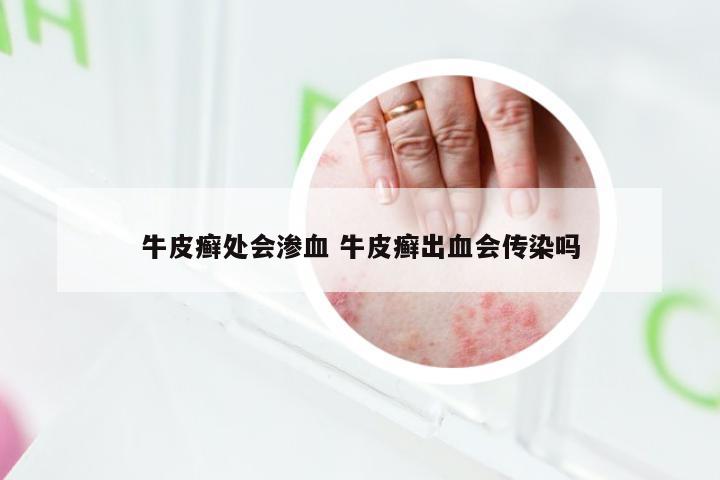 牛皮癣处会渗血 牛皮癣出血会传染吗
