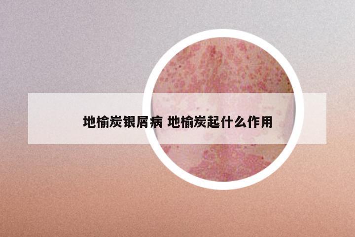 地榆炭银屑病 地榆炭起什么作用