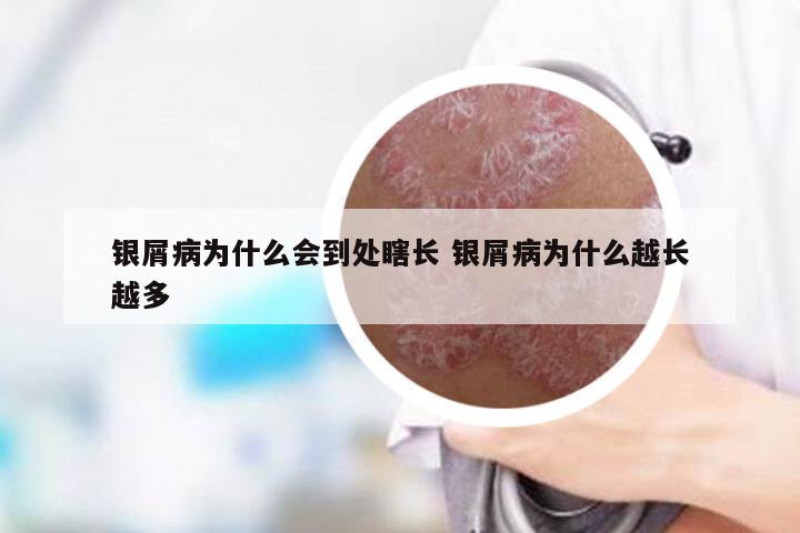 银屑病为什么会到处瞎长 银屑病为什么越长越多