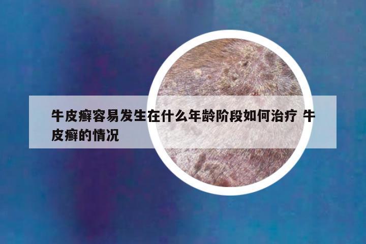 牛皮癣容易发生在什么年龄阶段如何治疗 牛皮癣的情况
