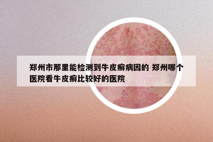 郑州市那里能检测到牛皮癣病因的 郑州哪个医院看牛皮癣比较好的医院