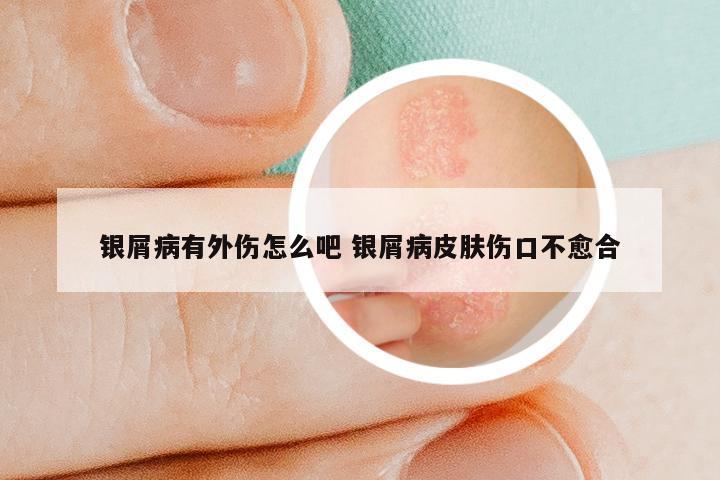 银屑病有外伤怎么吧 银屑病皮肤伤口不愈合