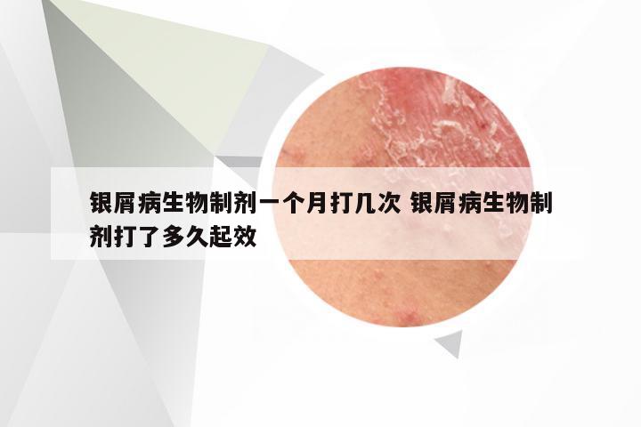 银屑病生物制剂一个月打几次 银屑病生物制剂打了多久起效