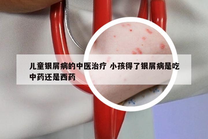 儿童银屑病的中医治疗 小孩得了银屑病是吃中药还是西药