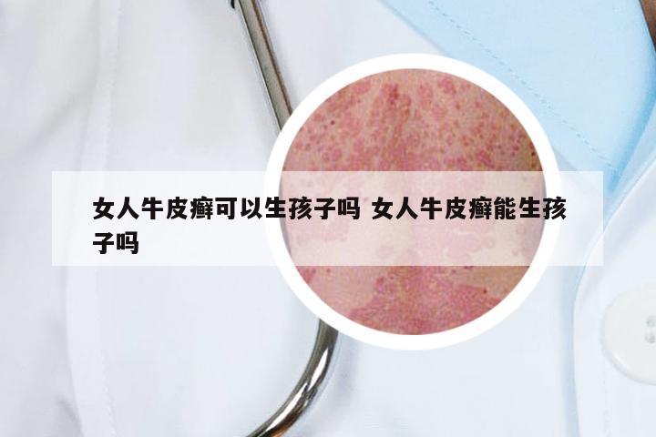 女人牛皮癣可以生孩子吗 女人牛皮癣能生孩子吗