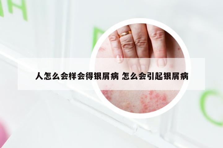 人怎么会样会得银屑病 怎么会引起银屑病
