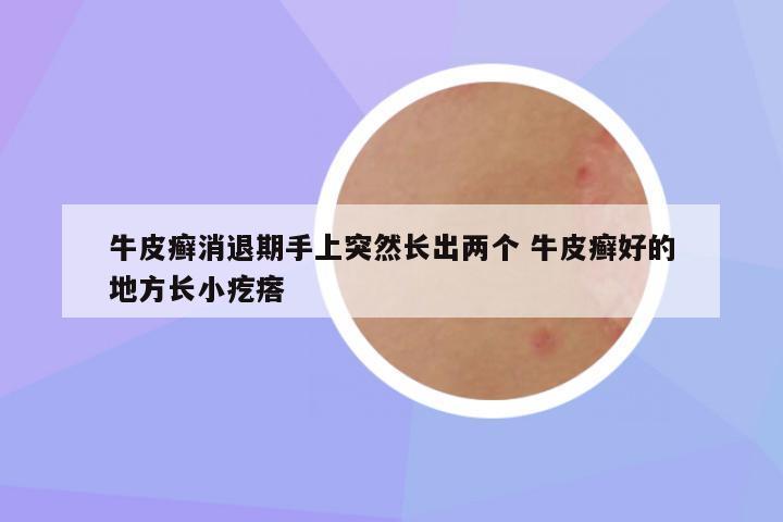 牛皮癣消退期手上突然长出两个 牛皮癣好的地方长小疙瘩