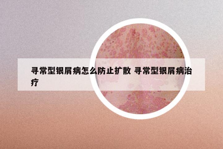 寻常型银屑病怎么防止扩散 寻常型银屑病治疗