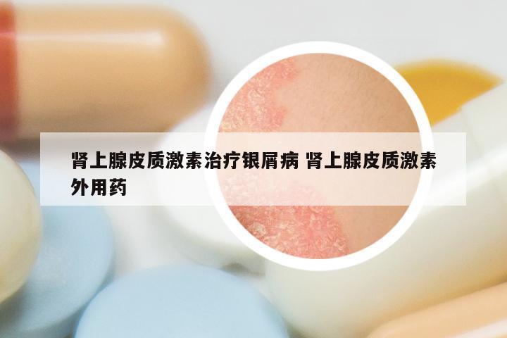 肾上腺皮质激素治疗银屑病 肾上腺皮质激素外用药