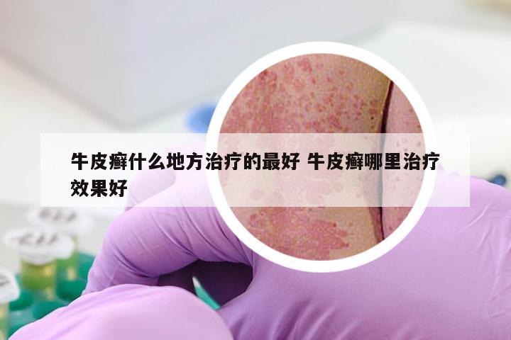 牛皮癣什么地方治疗的最好 牛皮癣哪里治疗效果好