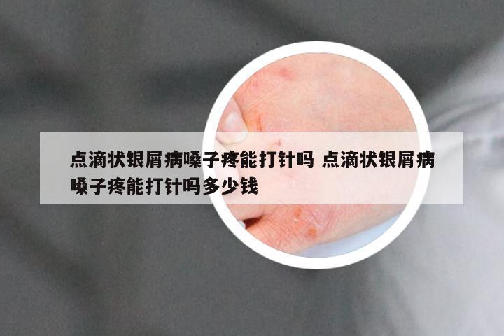 点滴状银屑病嗓子疼能打针吗 点滴状银屑病嗓子疼能打针吗多少钱