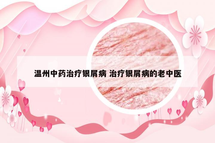 温州中药治疗银屑病 治疗银屑病的老中医