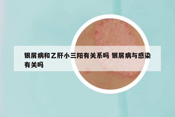 银屑病和乙肝小三阳有关系吗 银屑病与感染有关吗