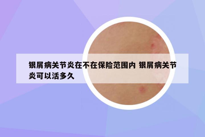 银屑病关节炎在不在保险范围内 银屑病关节炎可以活多久