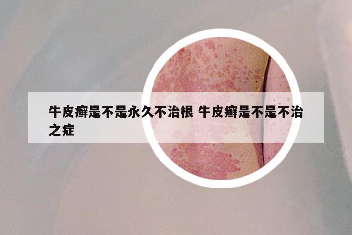 牛皮癣是不是永久不治根 牛皮癣是不是不治之症
