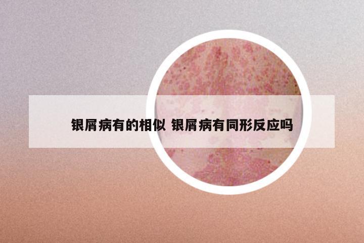 银屑病有的相似 银屑病有同形反应吗