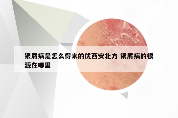 银屑病是怎么得来的优西安北方 银屑病的根源在哪里