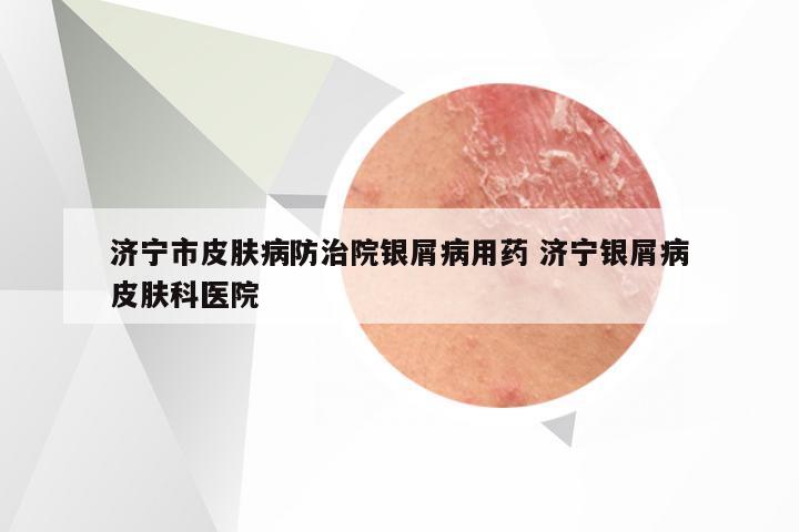 济宁市皮肤病防治院银屑病用药 济宁银屑病皮肤科医院