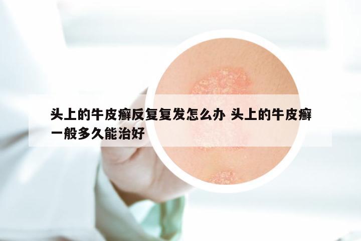 头上的牛皮癣反复复发怎么办 头上的牛皮癣一般多久能治好